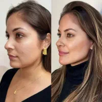 ژل و بوتاکس prp مزوژل فیلربادی پیرسینگ نخ لاغری
