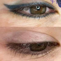 تتوهای قدیمی رو از صورتت پاک کن