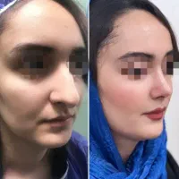 جراحی زیبایی بینی از دم قسط