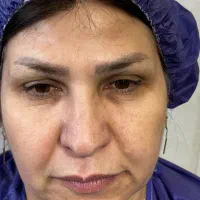 کاشت ابروی طبیعی