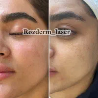 ریمو کک و مک و لک در یک جلسه (با تست رایگان)