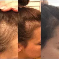 کاهش چربی سر و رویش دوباره
