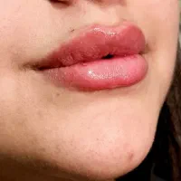 تزریق فیلر و بوتاکس