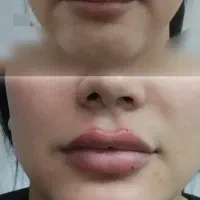 ژل لب، بوتاکس، شقیقه، گونه، جوانسازی