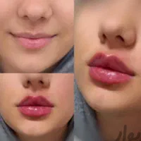 پی ار پیprpفیلرژل بوتاکس کامپوزیت فیشیال