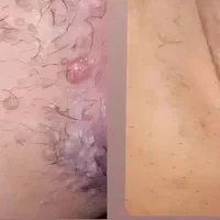 بهبودی زائده های گوشتی