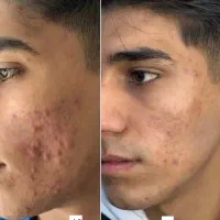 امورزش رفع جا جوش با جدیدترین تکنیک ها