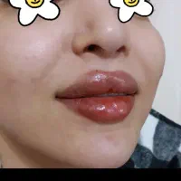 تزریق ژل و بوتاکس و آموزش