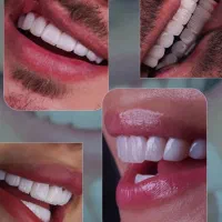 آموزش دوره های کامپوزیت/دندانپزشکی