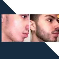 خداحافظی با کم‌مویی