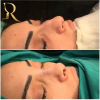 جراحی زیبایی بینی(رینوپلاستی)