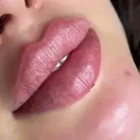 ژل و بوتاکس