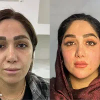آف ویژه تزریق فول فیس در اهواز
