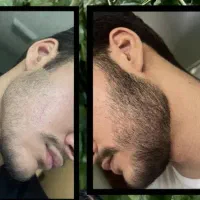 رویش. دوباره مو.و ریش. ۱ماه