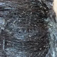 محلول پاکسازی رشک و شپش