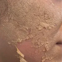 فیشال تخصصی و درمانی ،تحت نظر پزشک