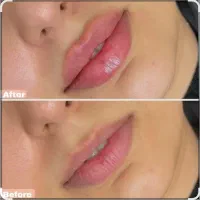 لیزر تاتو لیزر مو فیشیال لیزر کربن تزریق ژل