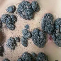 درمان ریشه ای زگیل و تبخال تناسلی