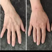 آموزش صفر تا صد ژل وبوتاکس وبادی و مزو و امبدینگ