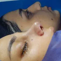 عمل بینی استخوانی وگوشتی توسط فوق تخصص پلاستیک