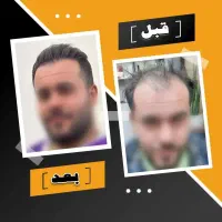 تنها مرکز تخصصی کاشت مو و ابرو + شرایط ویژه اقساط