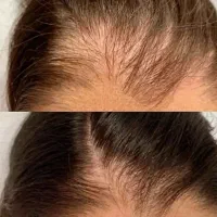 اگر ریزش شدید موی سر داری و کلافه شدی من اینجام