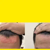 پسوریازیس / اگزما / حساسیت پوستی / پیسی