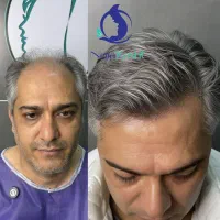 نژا کاشت مجموعه تخصصی کاشت مو و ابرو از سال 1383