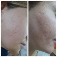 مزوتراپی و PRP / صورت ، دست و گردن