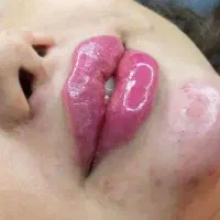 جشنواره ژل وبوتاکس ۴۹۰ الی ۸۹۰