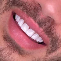 عصب کشی،ایمپلنت،کامپوزیت،ارتودنسی