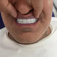 انواع دندانهای متحرک و ثابت.pfm و تمام سرامیک