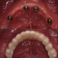 دندانپزشکی اوردنچر دو فک فقط127تومن،اقساطی