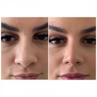 دستگاه کوچک کننده بینی در خانه