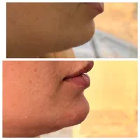 تزریق ژل لب(مدل گیری محدود)با متریال اوجینال