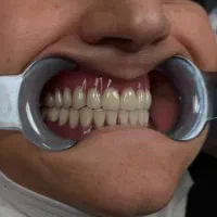 تخفیفات عیدانه دندانپزشکی،دسته دندان تضمینی