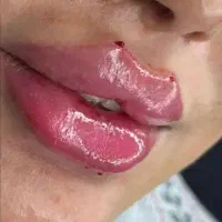 پی آرپی مزوتراپی کربن تراپی لاغری هایفو امبدینگ