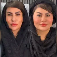 جشنواره تخصصی روش های نوین ژل فیلر بایو prp