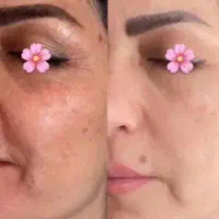 از شر تیرگی بدنتون خلاص بشید