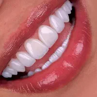 جشنواره/دندانپزشکی/عصب کشی‌/کشیدن/پرکردن