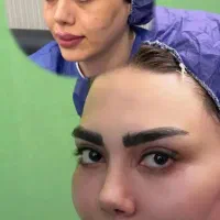 آموزش فیلربوتاکس گازی انزیم هیر نوا هایفوبیکینی