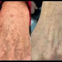 پی آرپی prp مزوتراپی مزونیدلینگ بوتاکس فشیال آنزیم