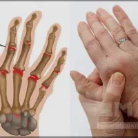 روماتیسم را جدی بگیرید اما به روش طبیعی