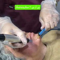 پی آر پی هیرفیلر ریزش مو PRP پی آر اف توسط پزشک