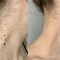 تخفیفات باور نکردین لیزرخال،زگیل تناسلی،لیزر تتو
