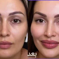 بوتاکس رایگان با تزریق ۲ سی سی ژل ( فیلر)