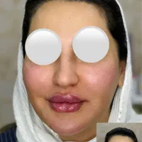 ژل و بوتاکس