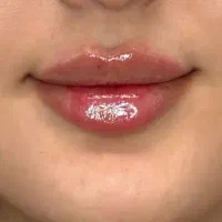تزریق فیلر صورت و بادی.بوتاکس و مزو ژل و نخ لیفت
