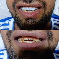 انجام کامپوزیت دندان و دندانسازی