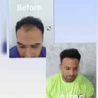کاشت مو یک روزه  ( ورتکس / شقیقه  )فقط ۸ میلیون